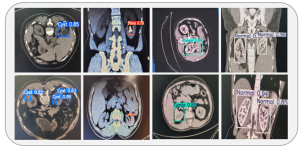 Lightweight Edge Intelligence for Detection of Kidney...